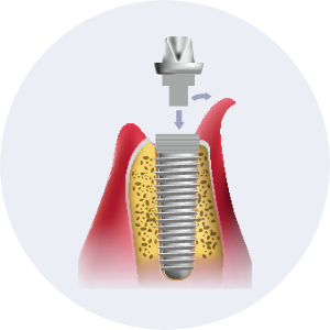 Dental Implant Process image2