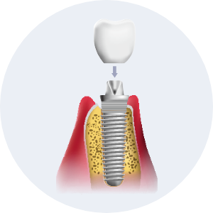 Dental Implant Process image3